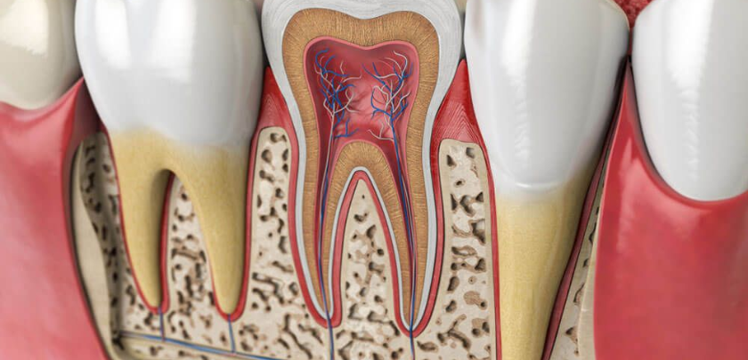 Root canal treatment diagram showing infected tooth