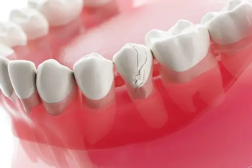 Cracked tooth restoration with dental crown