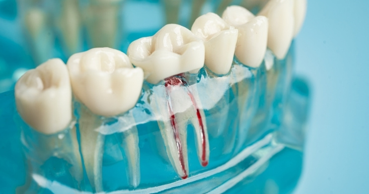 Dental crowns and root canal procedure illustration