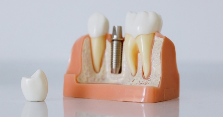 Illustration showing the effects of nutrition on dental implants