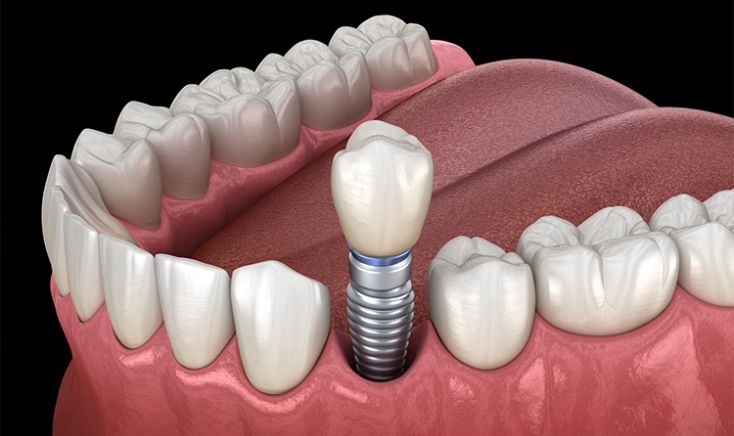 Dental implant placement and restoration illustration