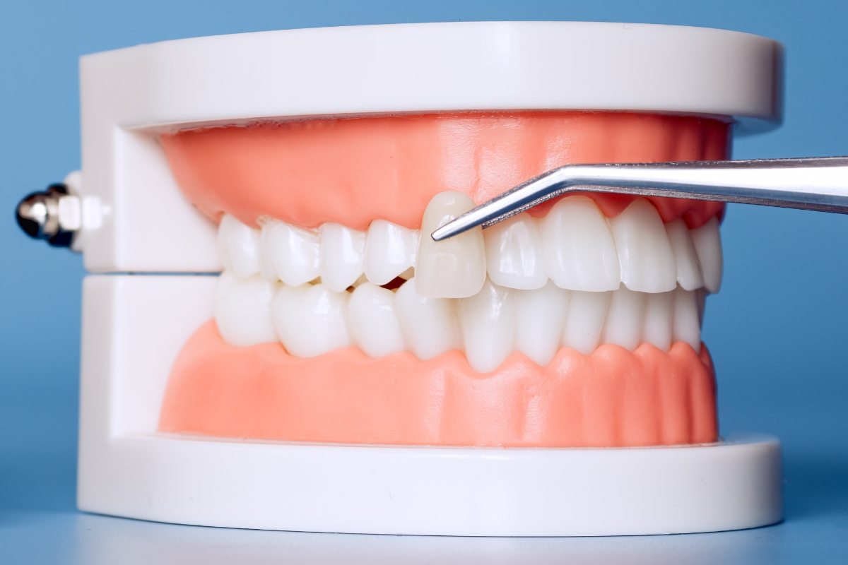 Dental veneer treatment improving smile appearance