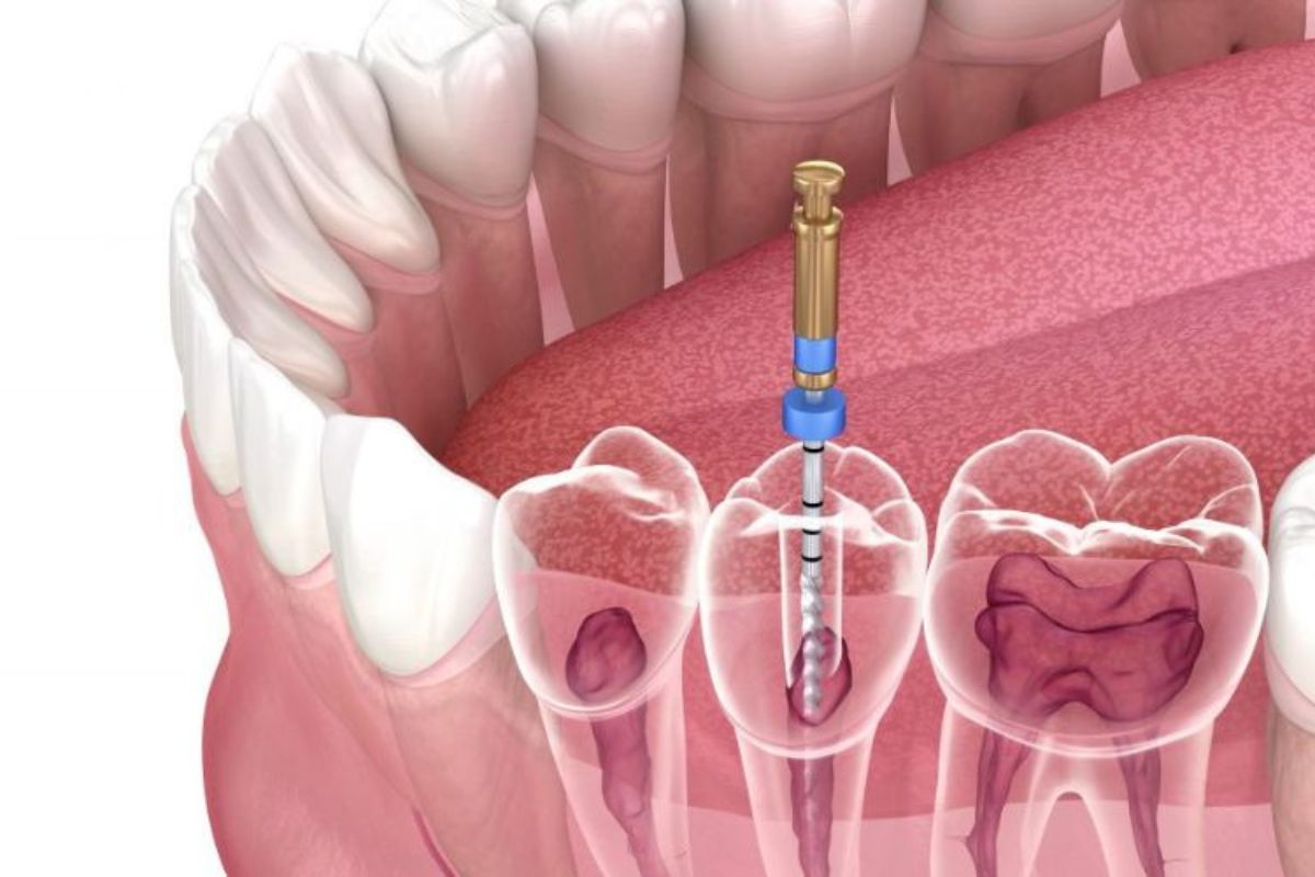 Root canal treatment illustration showing tooth anatomy