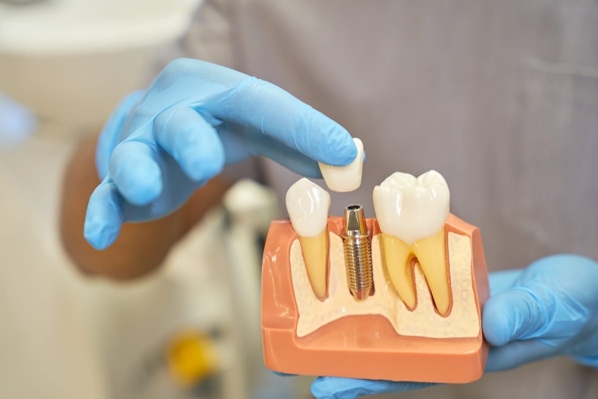 Dental implant models used for patient education
