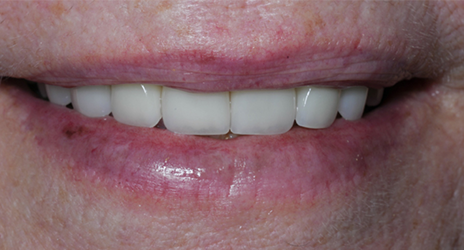 Close up of teeth after treatment at Broadway Dental of Millbrae