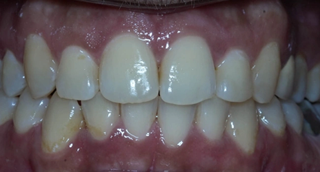Close up of teeth after treatment at Broadway Dental of Millbrae