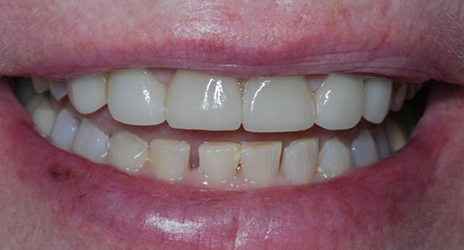 Close up of teeth before treatment at Broadway Dental of Millbrae