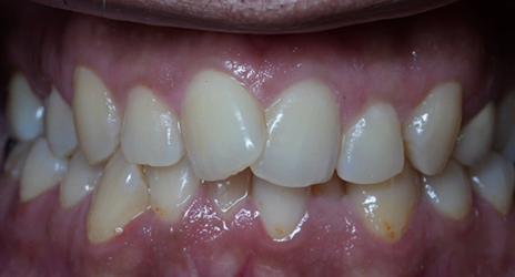 Close up of teeth before treatment at Broadway Dental of Millbrae