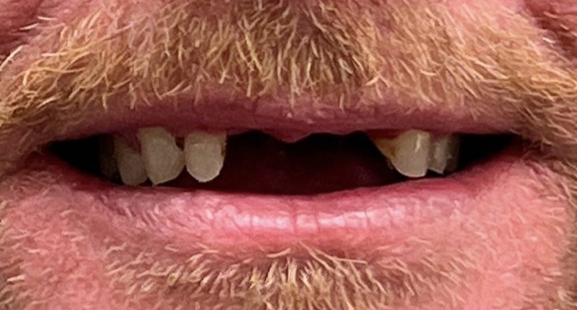 Full mouth reconstruction before treatment